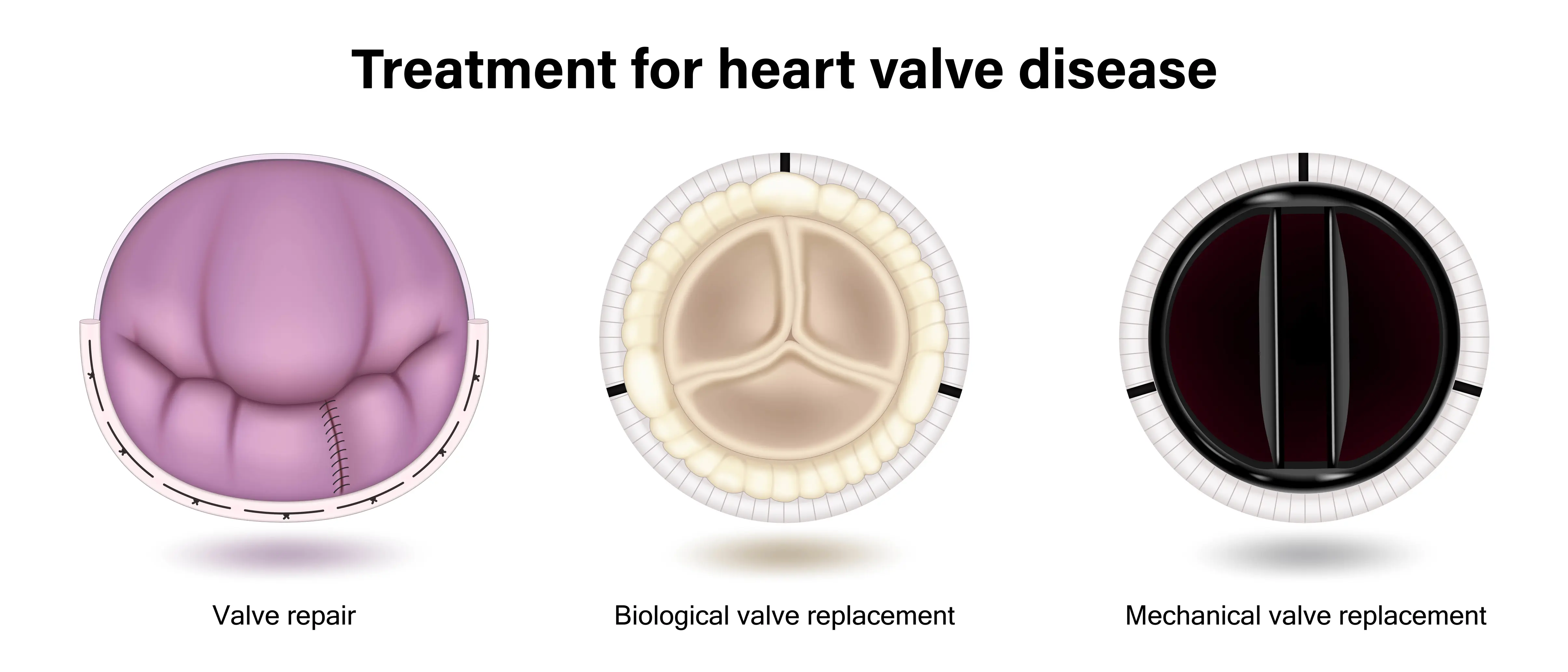 Mekanik Kapak Protezi: Hangi Durumlarda Kullanılır?