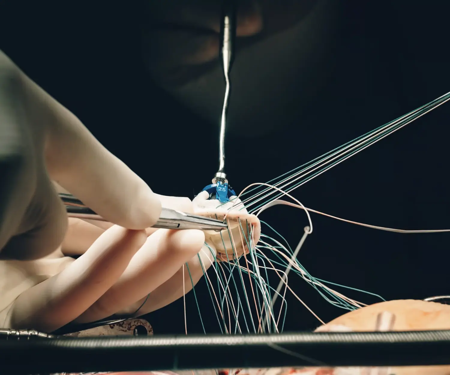 Kapalı Yöntem Kapak Ameliyatları