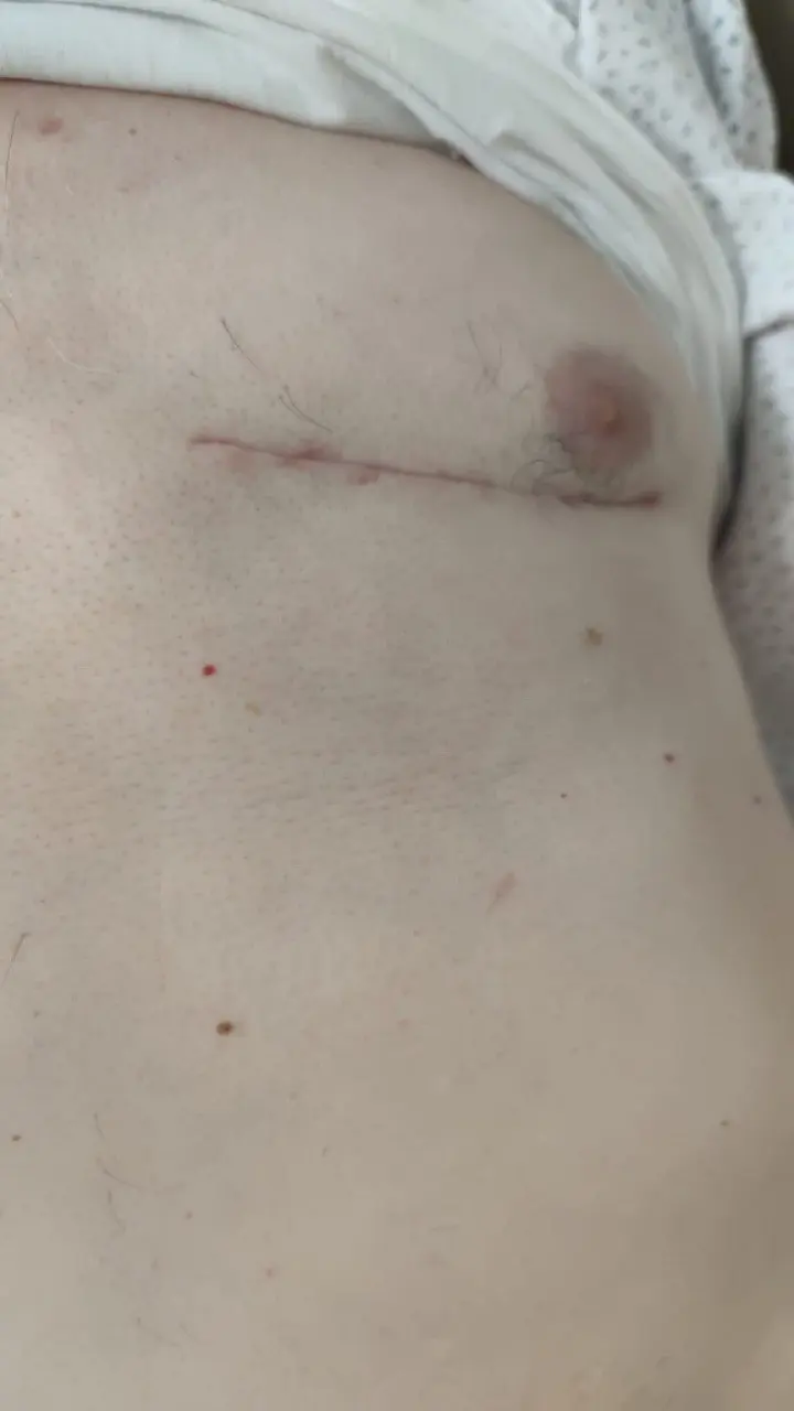 Kapalı Koroner Bypass: Avantajları ve Süreci