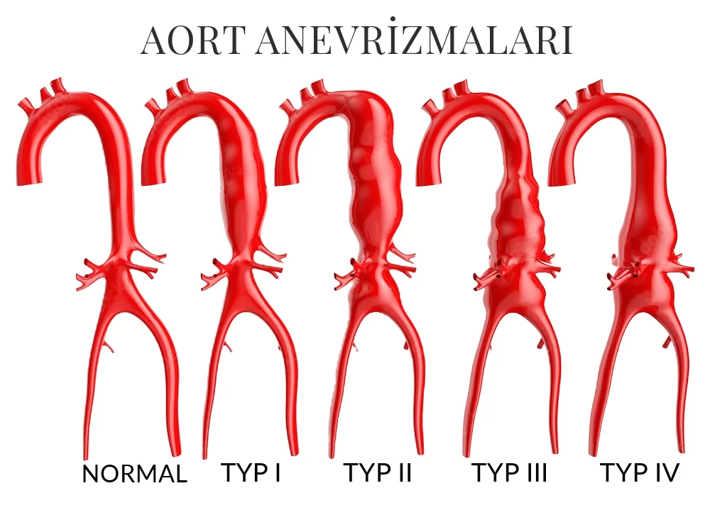 Aort Anevrizması ve Güncel Tedavi Seçenekleri